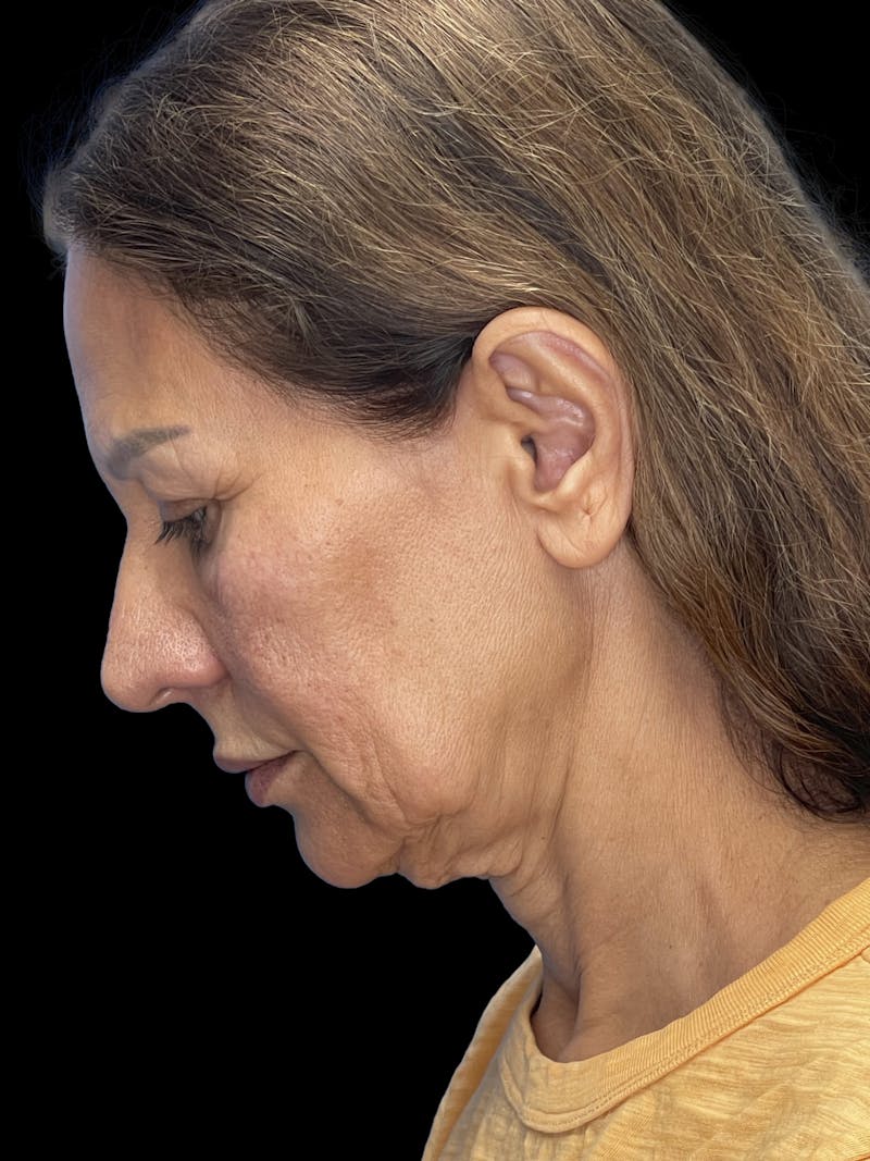 Deep Plane Facelift 60s Before & After Gallery - Patient 279154 - Image 5