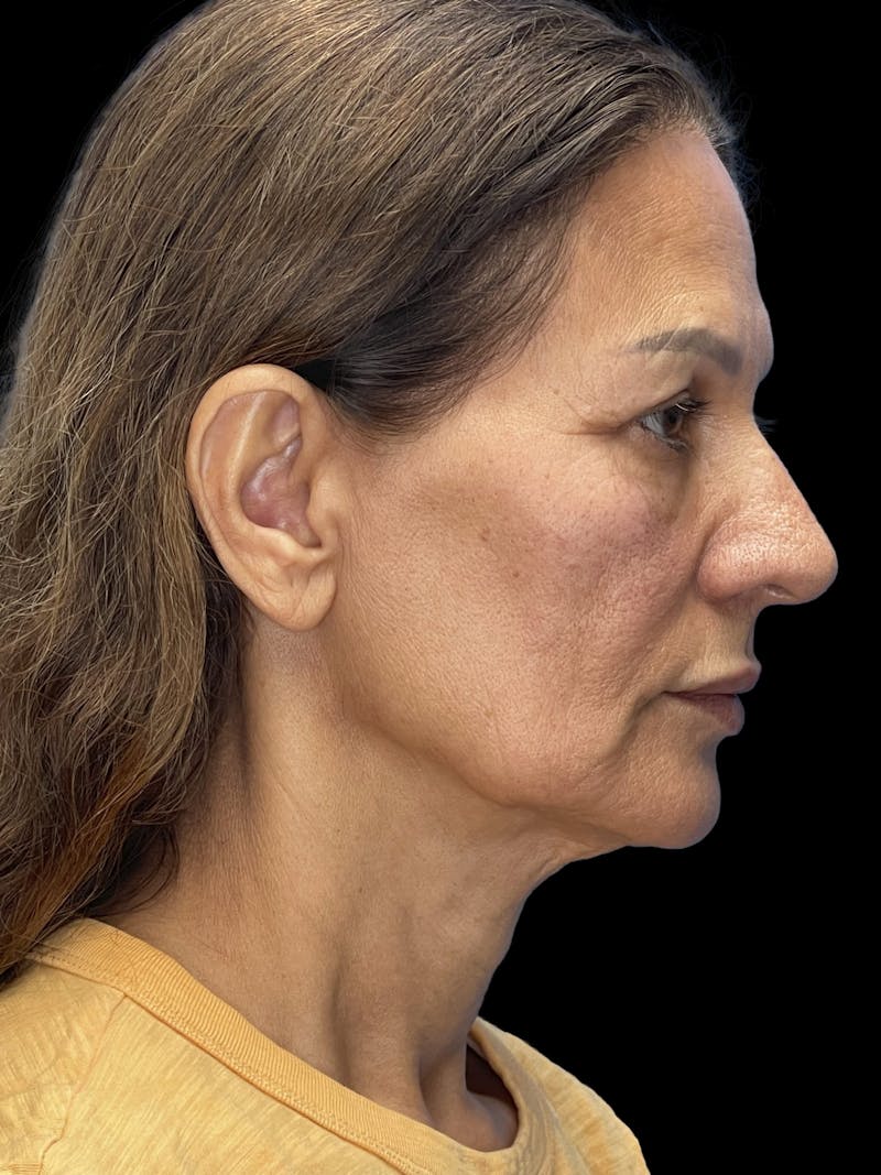 Deep Plane Facelift 60s Before & After Gallery - Patient 279154 - Image 9