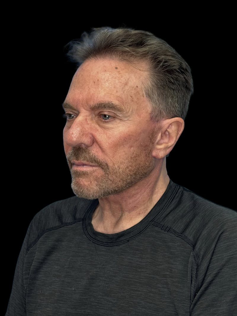Deep Plane Facelift 60s Before & After Gallery - Patient 105712 - Image 4