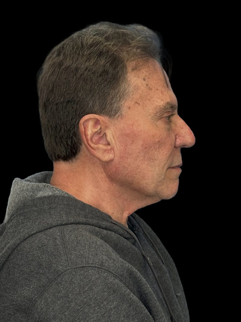 Deep Plane Facelift 60s Before & After Gallery - Patient 105712 - Image 7