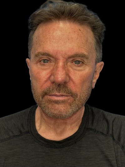 Deep Plane Facelift 60s Before & After Gallery - Patient 105712 - Image 2
