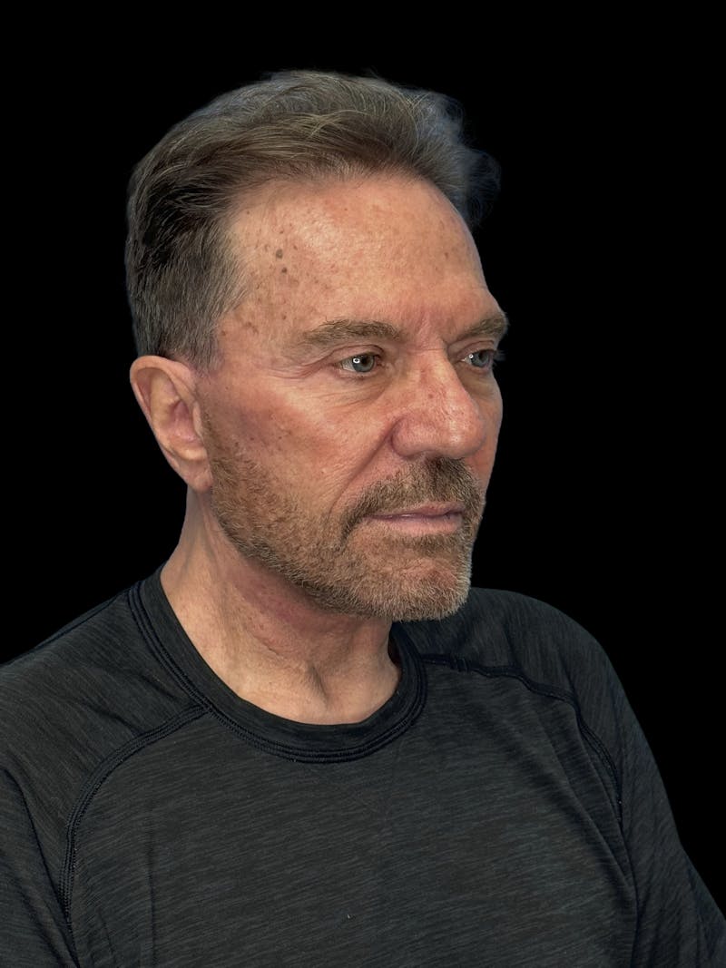 Deep Plane Facelift 60s Before & After Gallery - Patient 105712 - Image 6