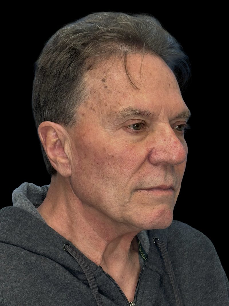 Deep Plane Facelift 60s Before & After Gallery - Patient 105712 - Image 5
