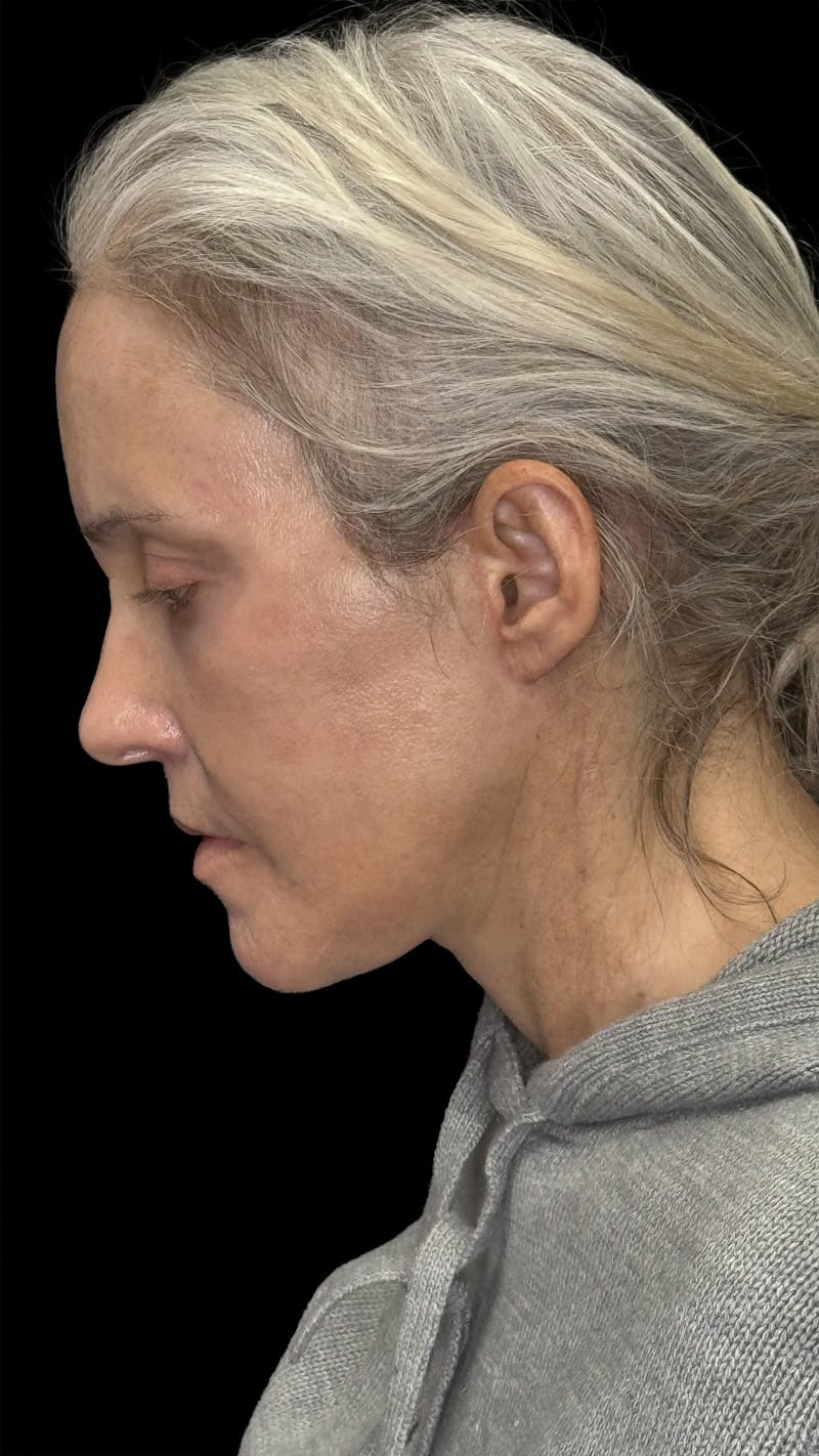 Deep Plane Facelift 50s Before & After Gallery - Patient 400682 - Image 14