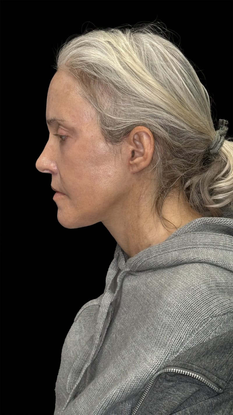 Deep Plane Facelift 50s Before & After Gallery - Patient 400682 - Image 12