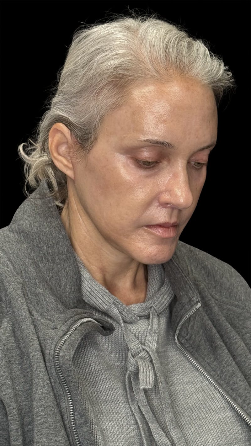 Deep Plane Facelift 50s Before & After Gallery - Patient 400682 - Image 10