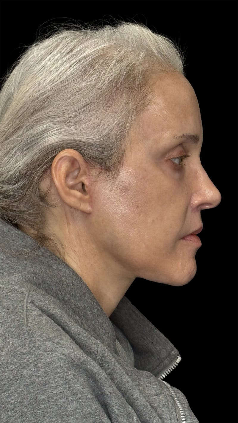 Deep Plane Facelift 50s Before & After Gallery - Patient 400682 - Image 6