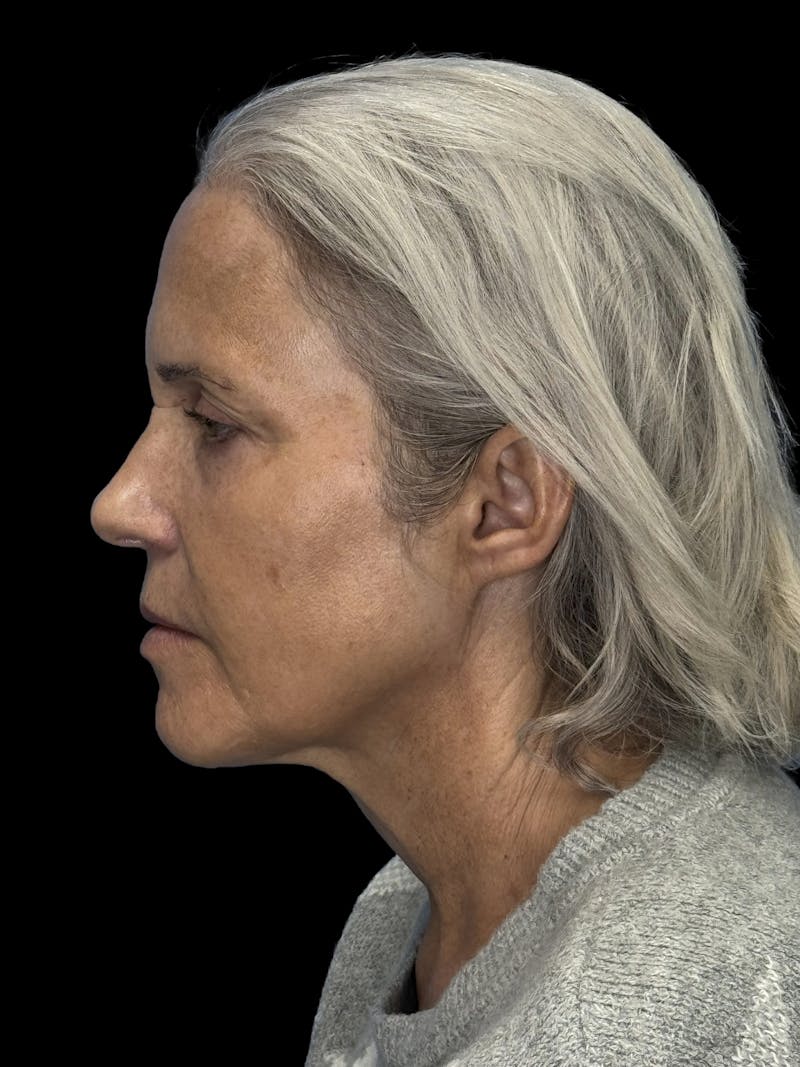 Deep Plane Facelift 50s Before & After Gallery - Patient 400682 - Image 13