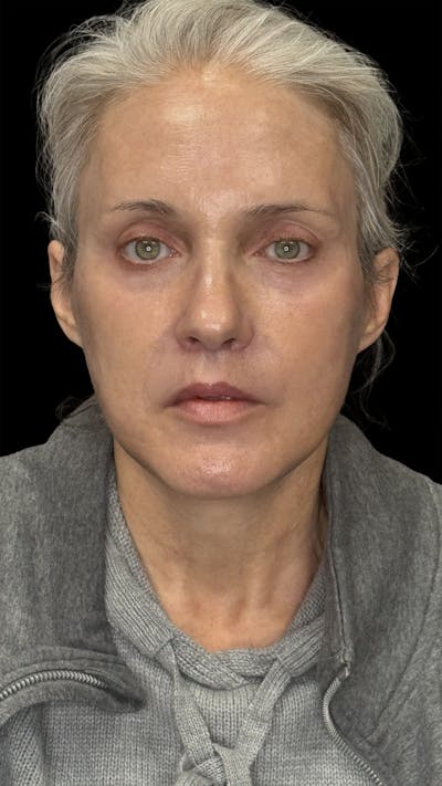 Deep Plane Facelift 50s Before & After Gallery - Patient 400682 - Image 2