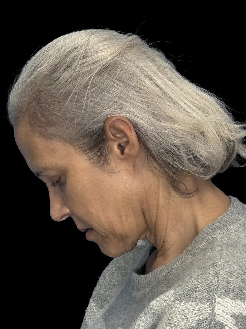 Deep Plane Facelift 50s Before & After Gallery - Patient 400682 - Image 11
