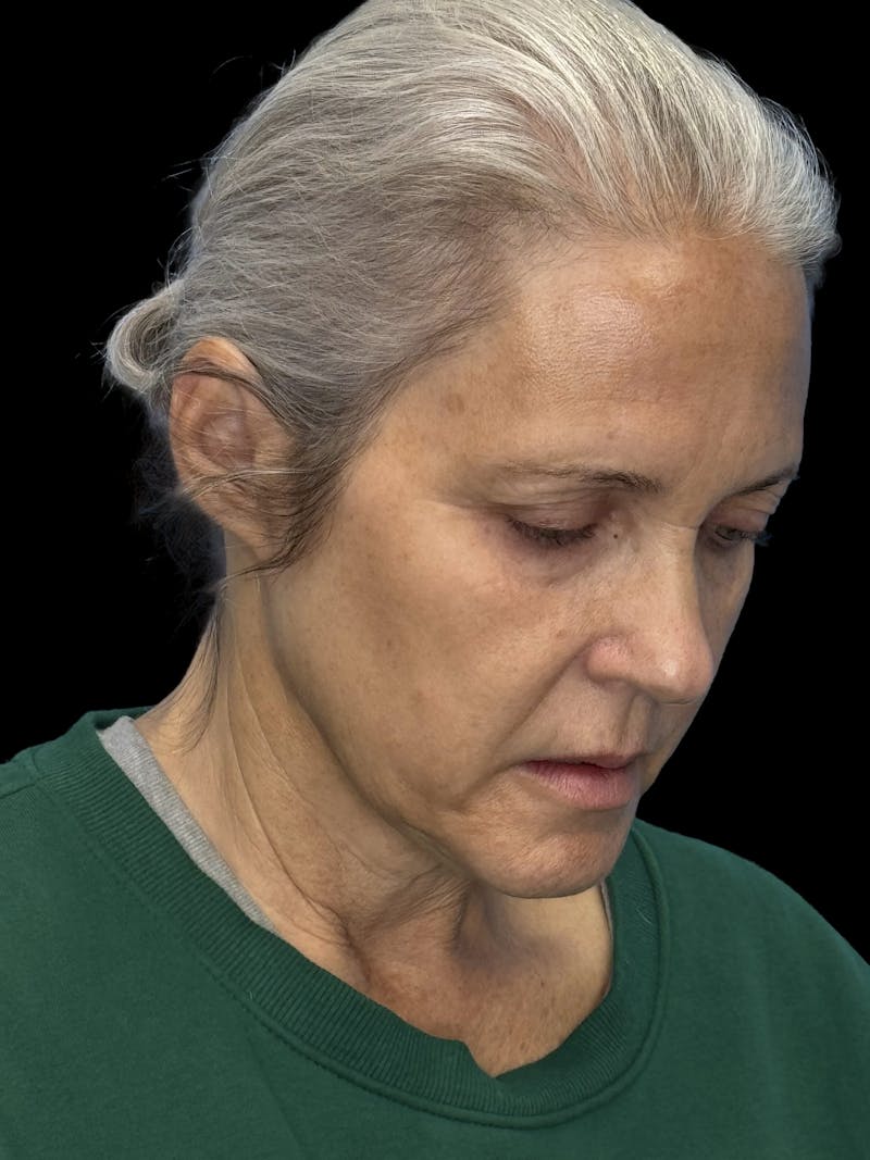 Deep Plane Facelift 50s Before & After Gallery - Patient 400682 - Image 9