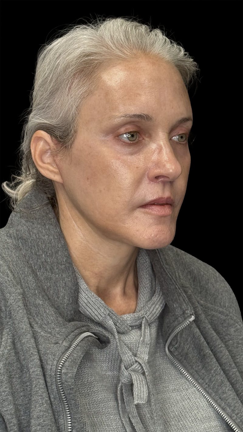 Deep Plane Facelift 50s Before & After Gallery - Patient 400682 - Image 4