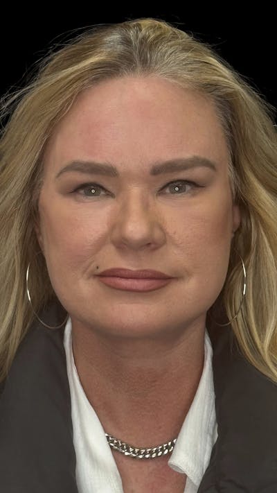 Deep Plane Facelift 50s Before & After Gallery - Patient 296828 - Image 2