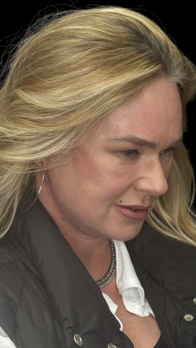 Deep Plane Facelift 50s Before & After Gallery - Patient 296828 - Image 6