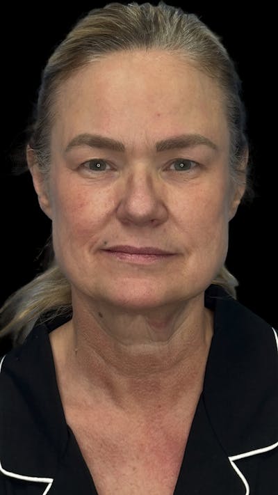 Deep Plane Facelift 50s Before & After Gallery - Patient 296828 - Image 1
