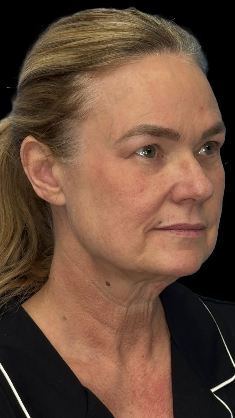 Brow Lift Before & After Gallery - Patient 380555 - Image 3