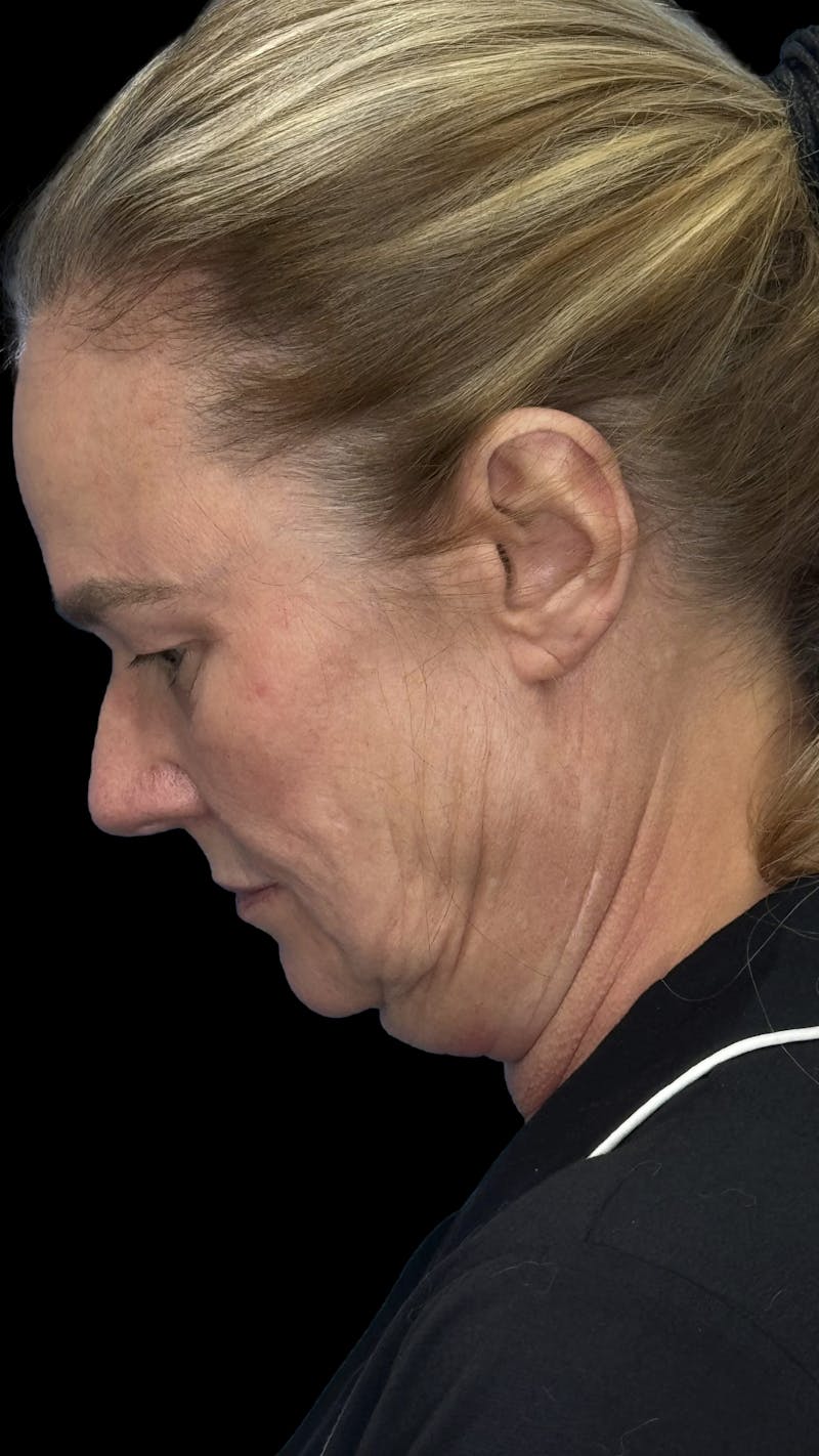 Deep Plane Facelift 50s Before & After Gallery - Patient 296828 - Image 9