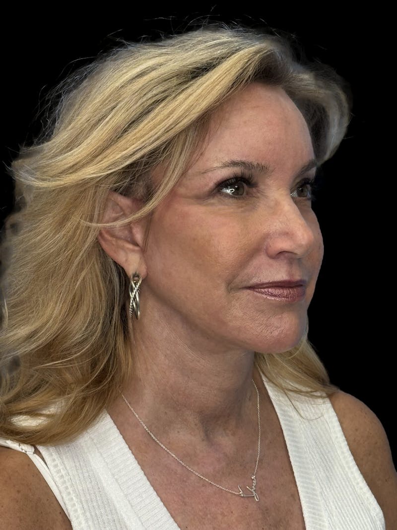 Deep Plane Facelift 50s Before & After Gallery - Patient 339877 - Image 8