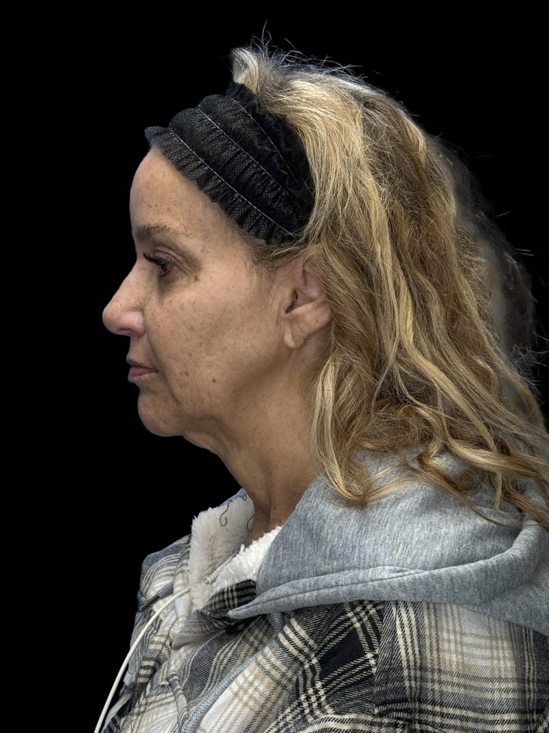 Deep Plane Facelift 50s Before & After Gallery - Patient 339877 - Image 5