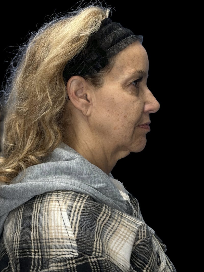 Deep Plane Facelift 50s Before & After Gallery - Patient 339877 - Image 9