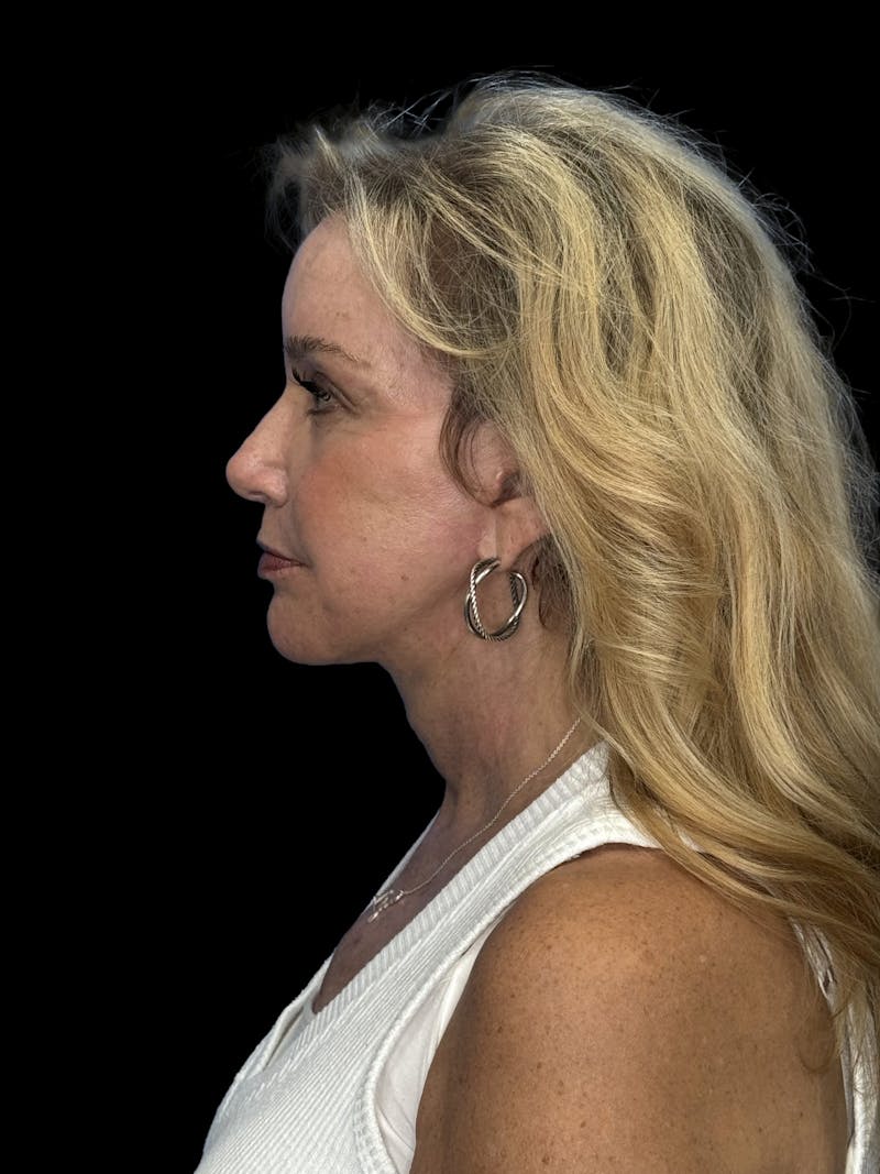 Deep Plane Facelift 50s Before & After Gallery - Patient 339877 - Image 6