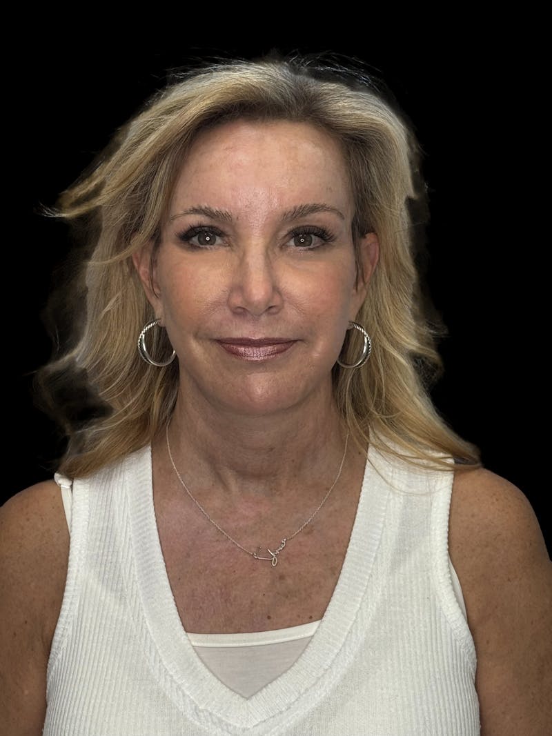 Deep Plane Facelift 50s Before & After Gallery - Patient 339877 - Image 2