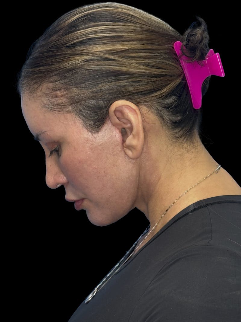 Deep Plane Facelift 50s Before & After Gallery - Patient 382719 - Image 10