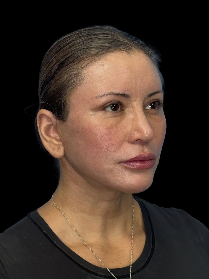 Deep Plane Facelift 50s Before & After Gallery - Patient 382719 - Image 8