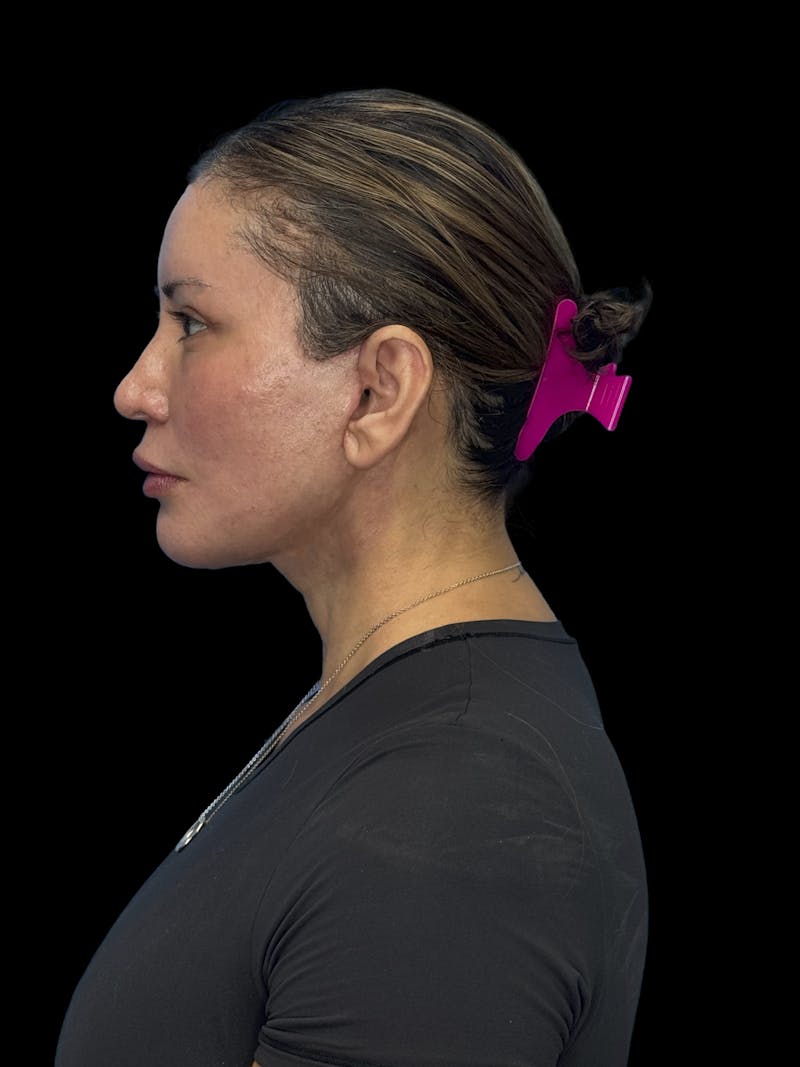 ContourLift Before & After Gallery - Patient 150055 - Image 8