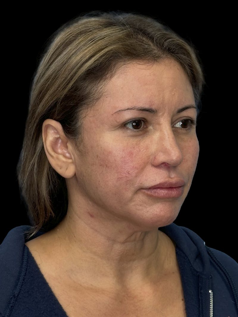 Deep Plane Facelift 50s Before & After Gallery - Patient 382719 - Image 7