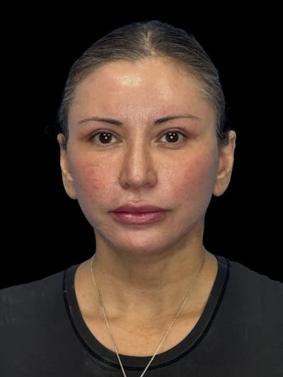 Deep Plane Facelift 50s Before & After Gallery - Patient 382719 - Image 2