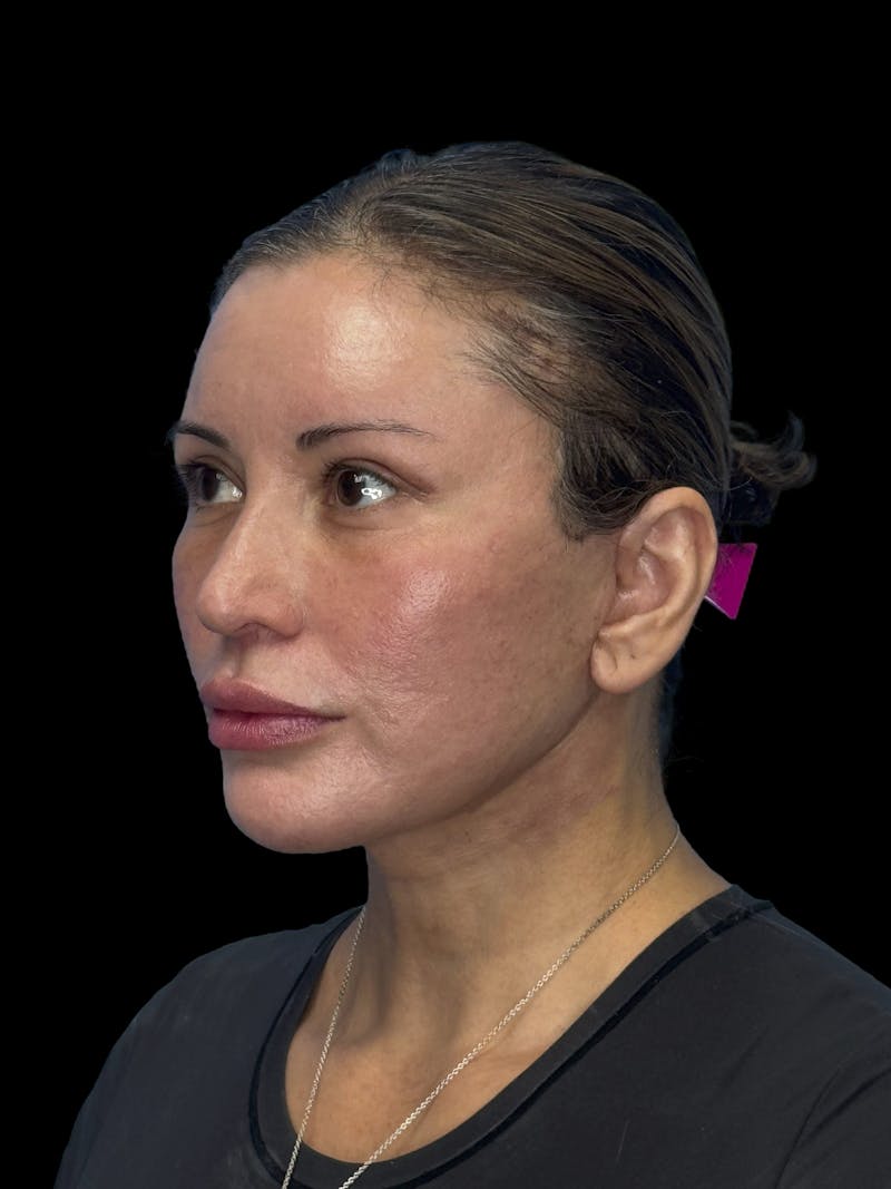 ContourLift Before & After Gallery - Patient 150055 - Image 4