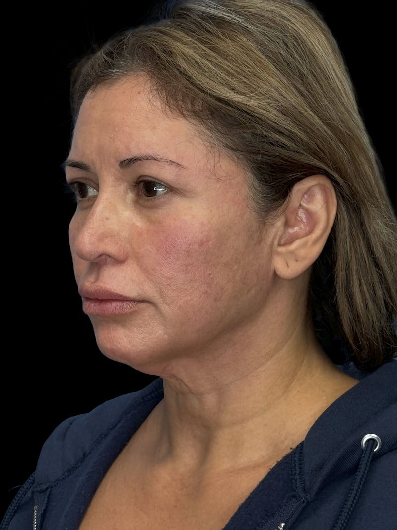 Deep Plane Facelift 50s Before & After Gallery - Patient 382719 - Image 3