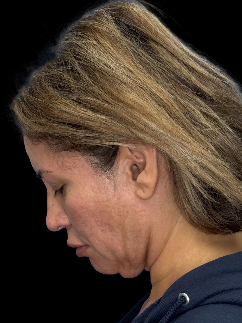 ContourLift Before & After Gallery - Patient 150055 - Image 5