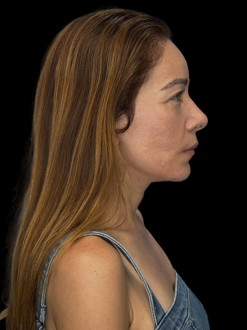 Deep Plane Facelift 50s Before & After Gallery - Patient 381623 - Image 10