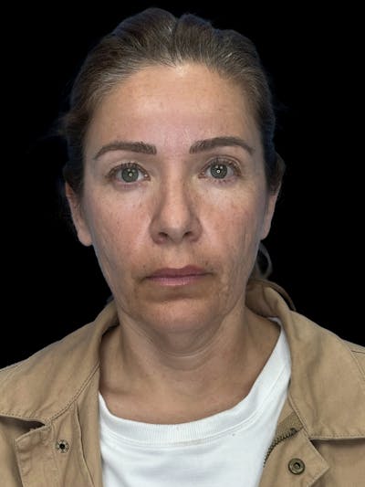 Deep Plane Facelift 50s Before & After Gallery - Patient 381623 - Image 1