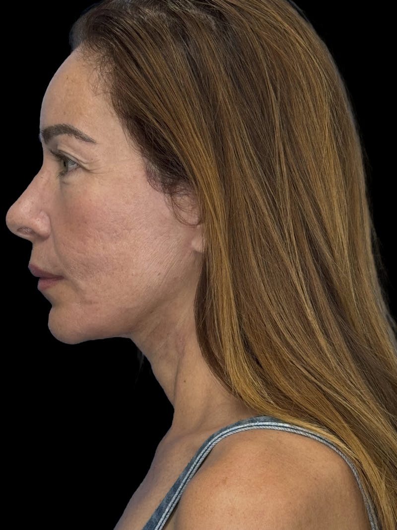 Deep Plane Facelift 50s Before & After Gallery - Patient 381623 - Image 6