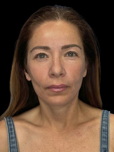 Deep Plane Facelift 50s Before & After Gallery - Patient 381623 - Image 2