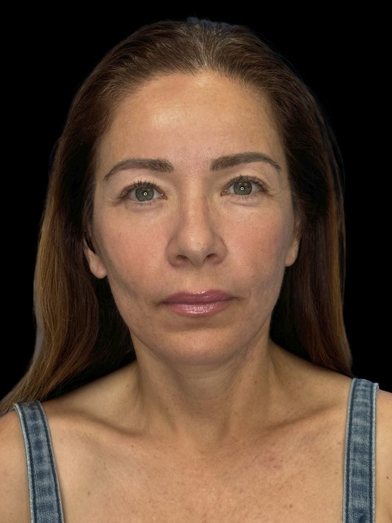 Deep Plane Facelift 50s Before & After Gallery - Patient 381623 - Image 2