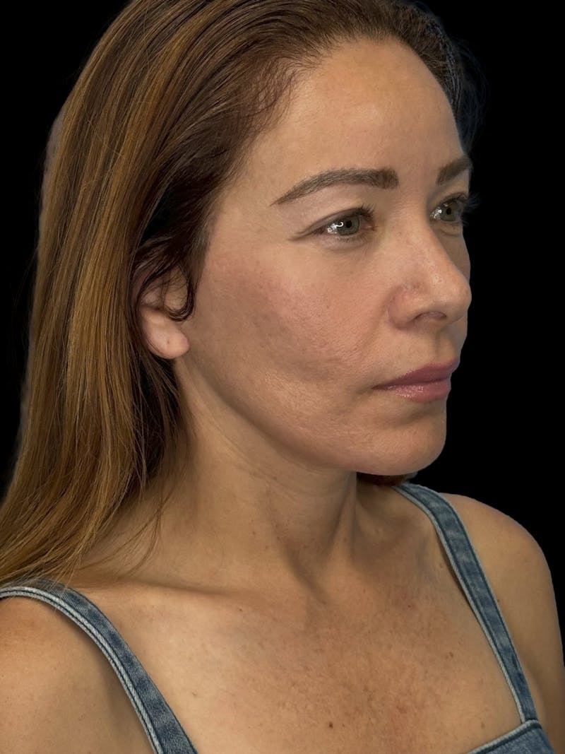 Deep Plane Facelift 50s Before & After Gallery - Patient 381623 - Image 8