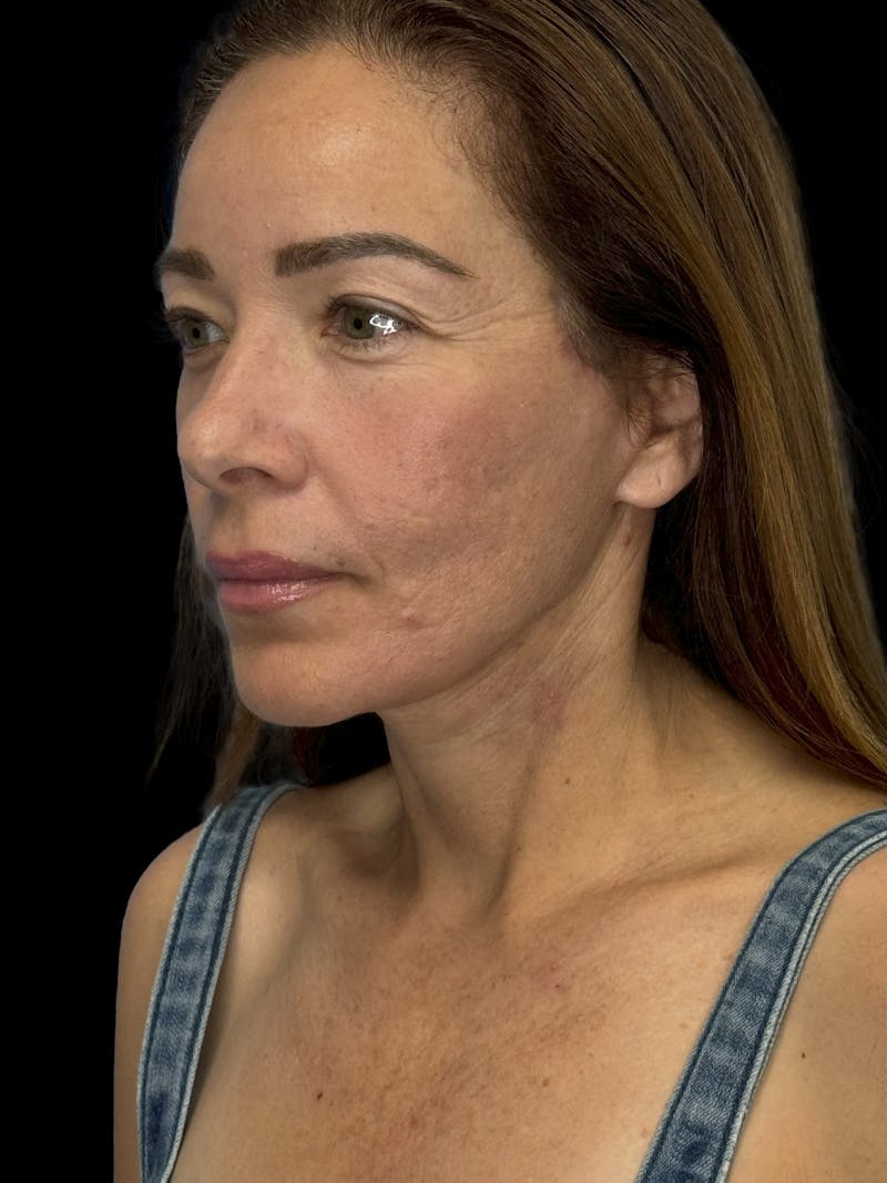 Deep Plane Facelift 50s Before & After Gallery - Patient 381623 - Image 4