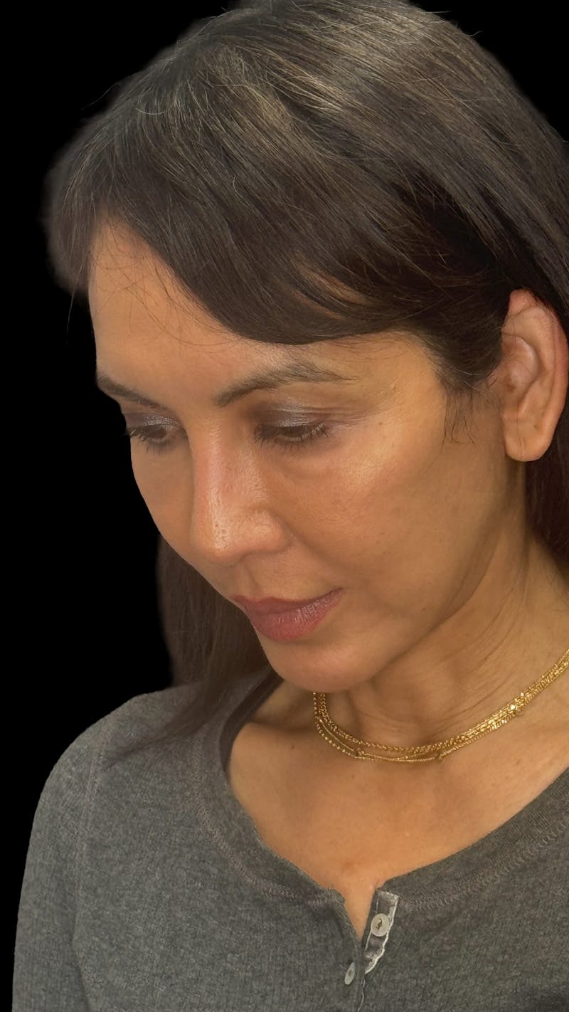 Deep Plane Facelift 50s Before & After Gallery - Patient 380369 - Image 8