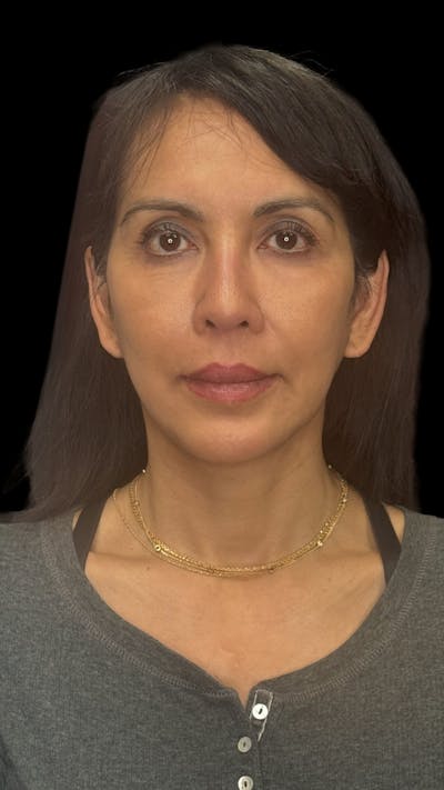 Deep Plane Facelift 50s Before & After Gallery - Patient 380369 - Image 2
