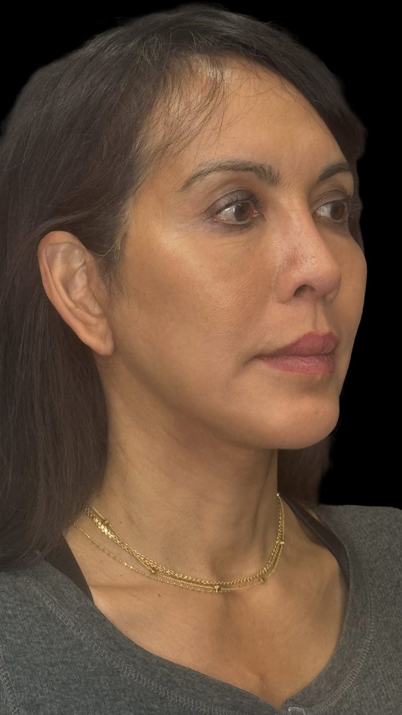 Deep Plane Facelift 50s Before & After Gallery - Patient 380369 - Image 4