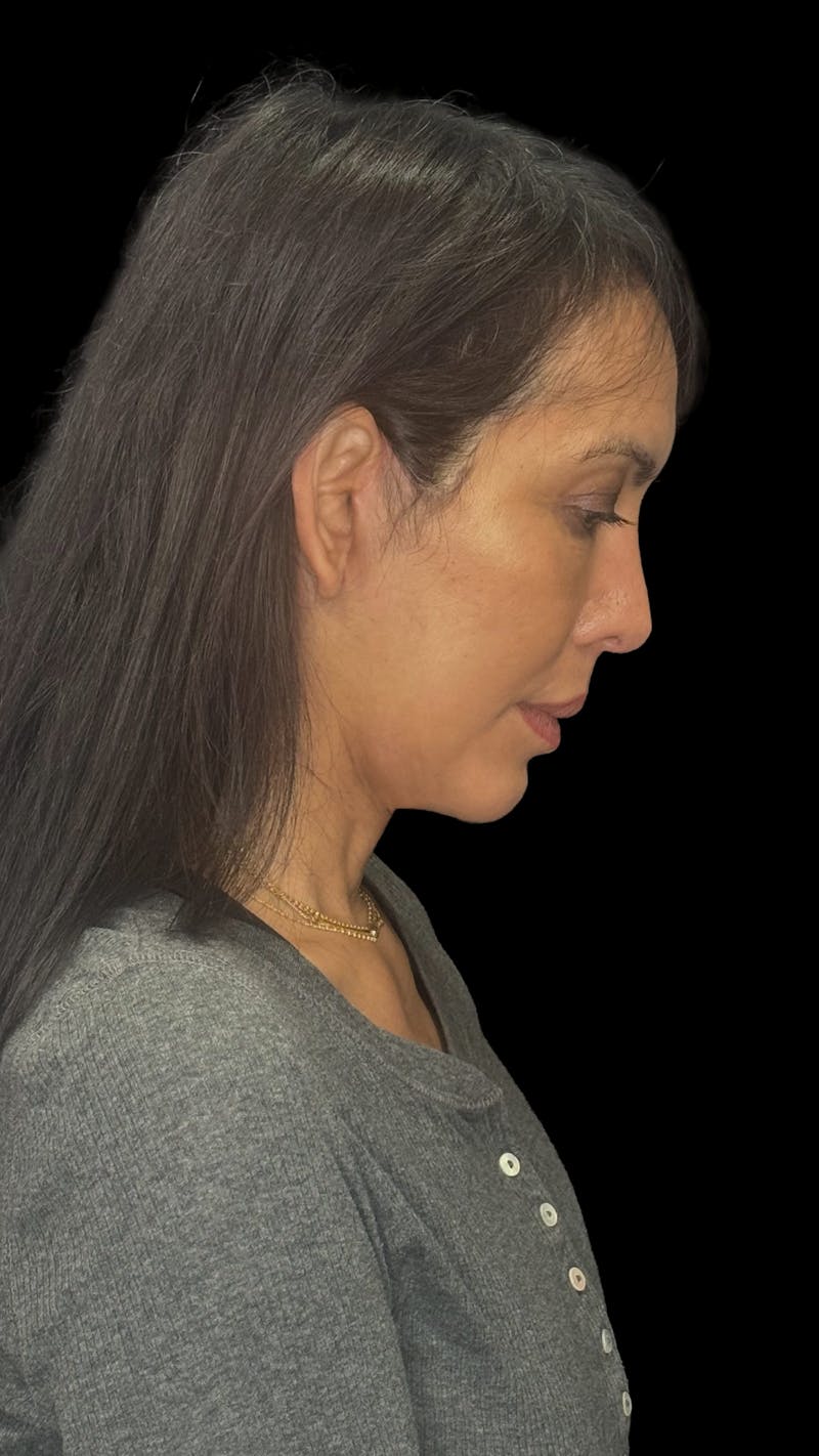 Deep Plane Facelift 50s Before & After Gallery - Patient 380369 - Image 10