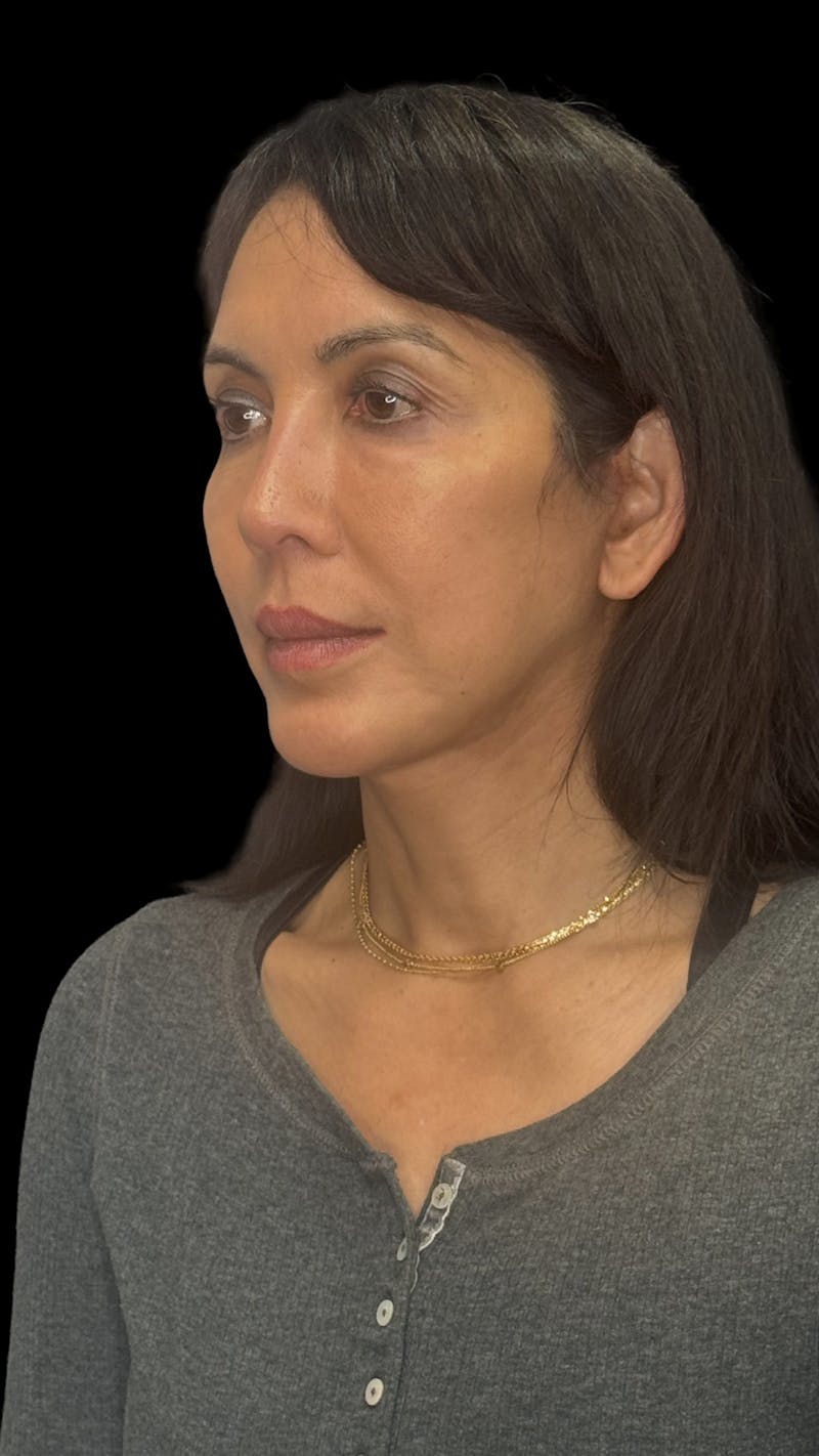 Deep Plane Facelift 50s Before & After Gallery - Patient 380369 - Image 6