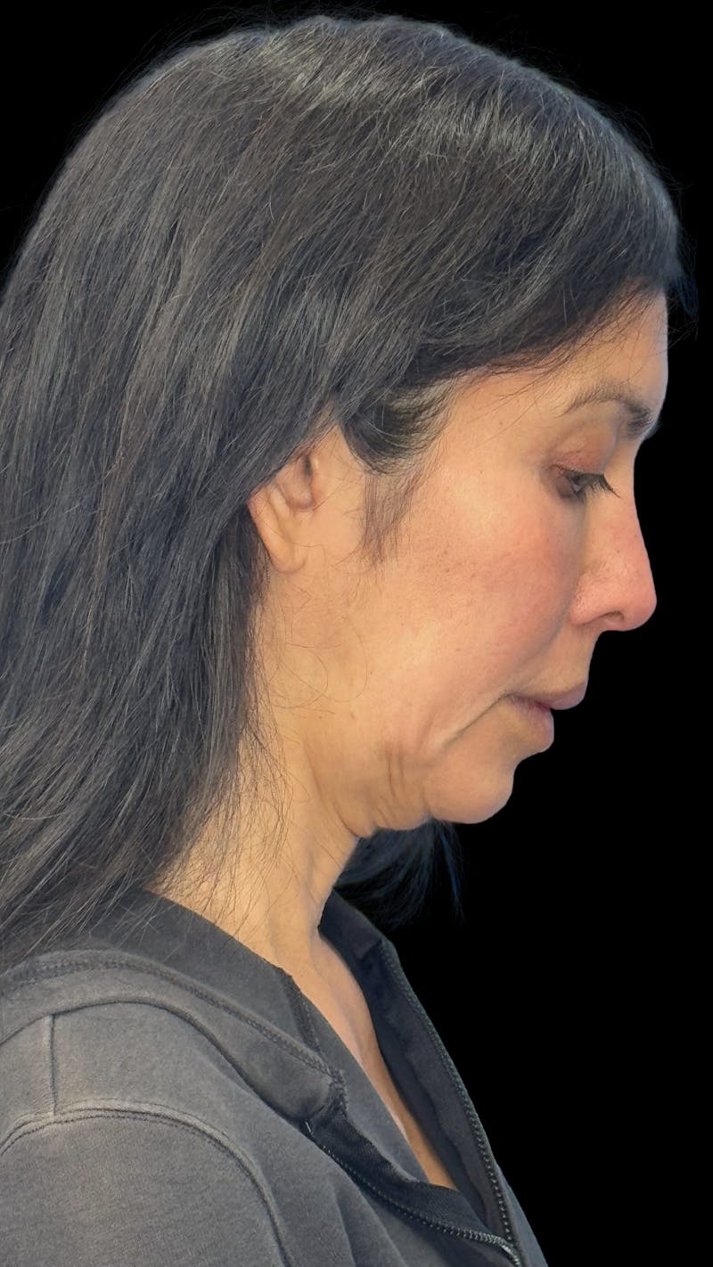 Deep Plane Facelift 50s Before & After Gallery - Patient 380369 - Image 9