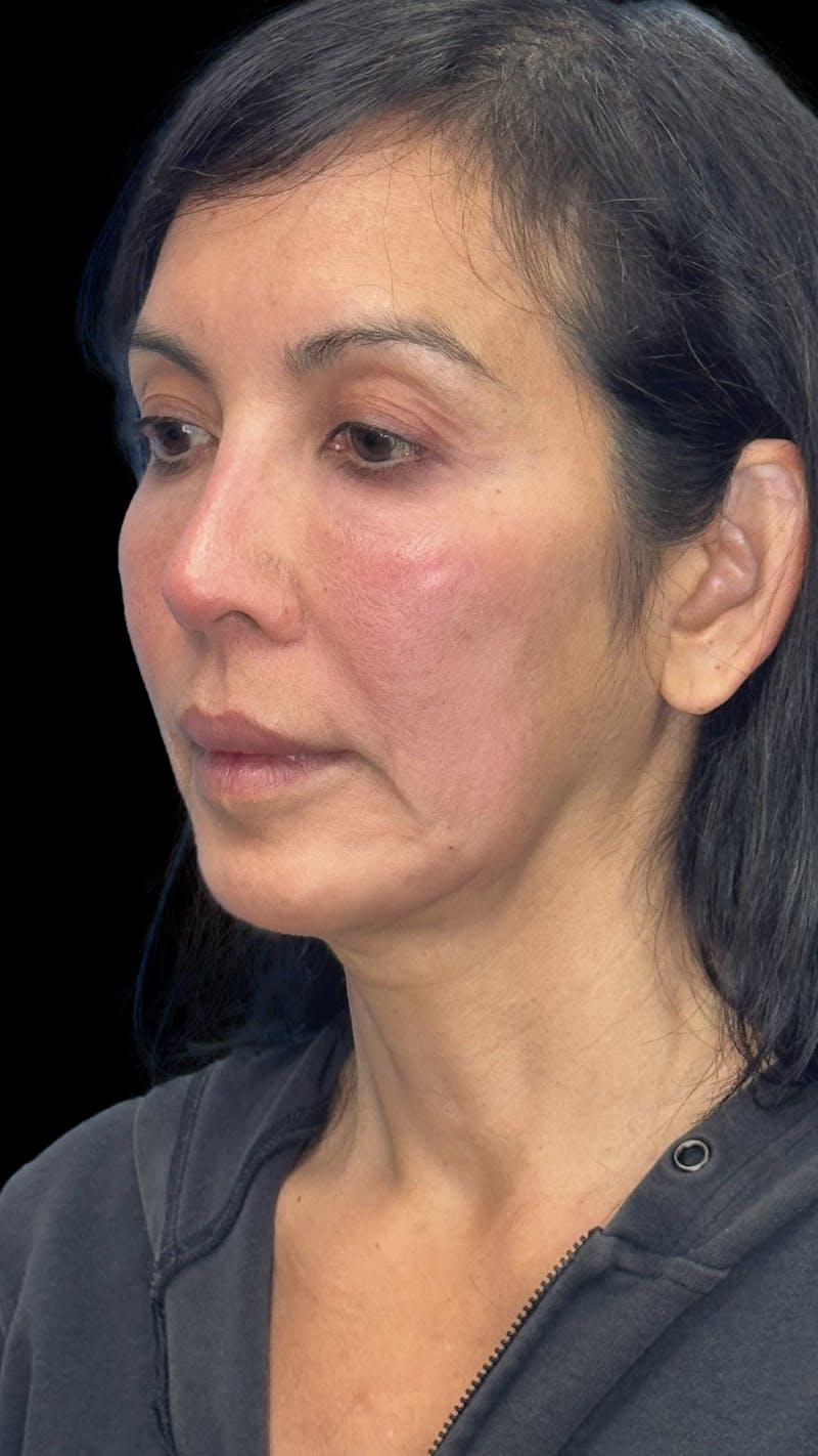 Deep Plane Facelift 50s Before & After Gallery - Patient 380369 - Image 5