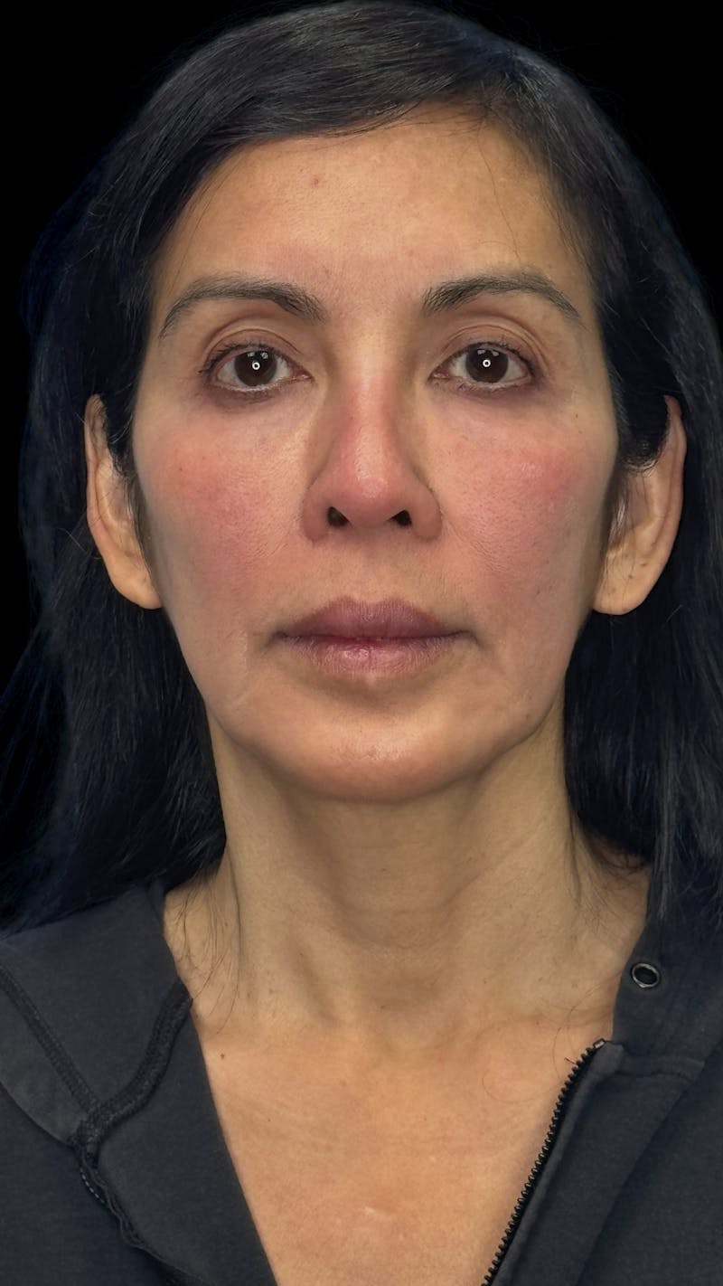 Deep Plane Facelift 50s Before & After Gallery - Patient 380369 - Image 1