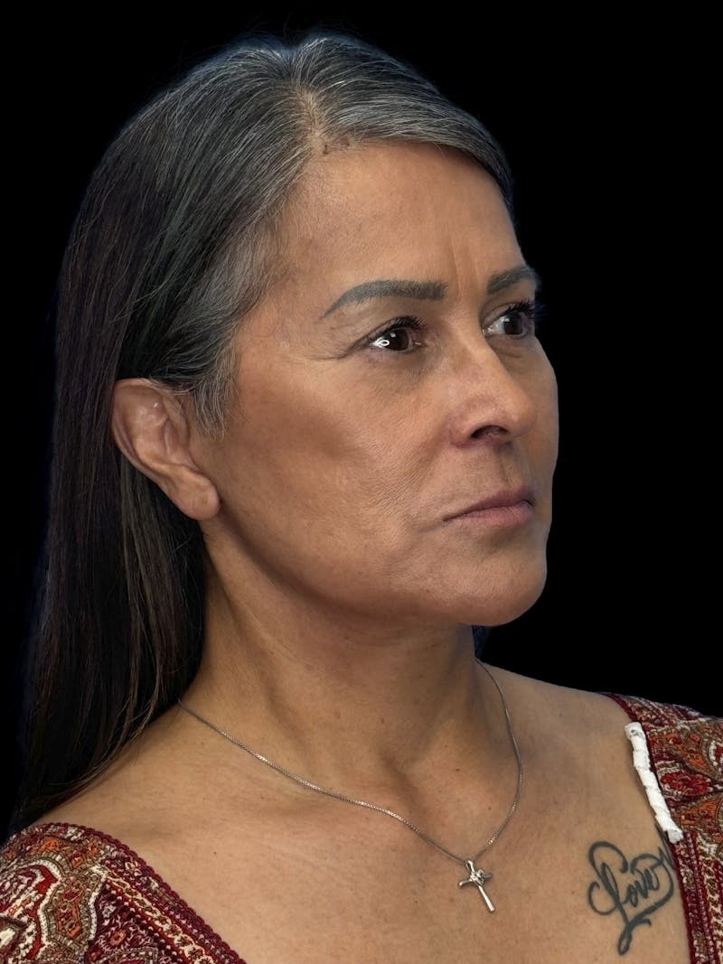 Deep Plane Facelift 50s Before & After Gallery - Patient 347296 - Image 8